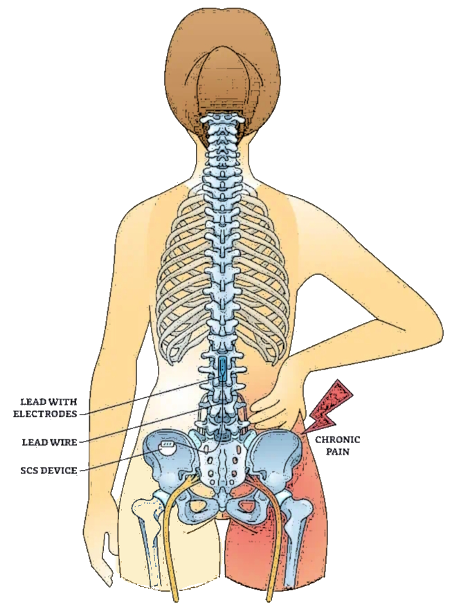 illustration spinal cord stimulation deposit695123706