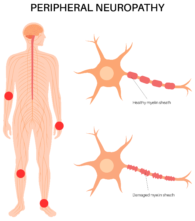 illustration peripheral neuropathy adobe902018975